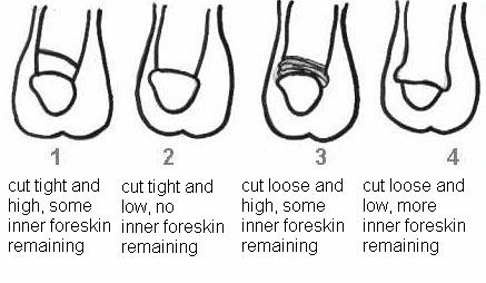 various degrees of circumcision